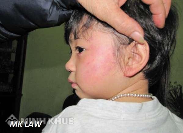 Tư vấn trách nhiệm của cô giáo đánh học sinh tiểu học
