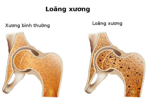 Hội chứng kém hấp thu thường xảy ra như thế nào?