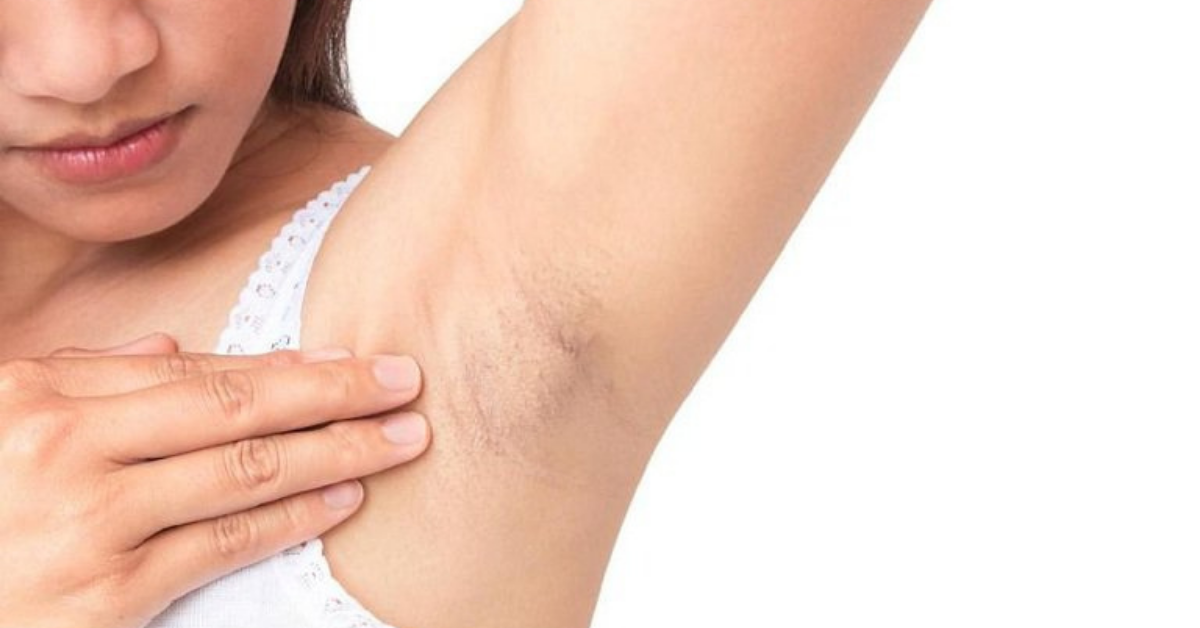 Tại sao ở nách lại mọc hạch?