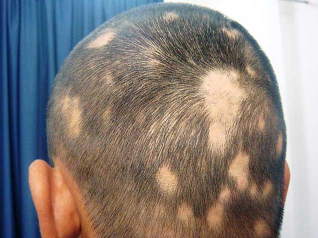 Một số lý do khiến bạn bị rụng lông trên cơ thể
