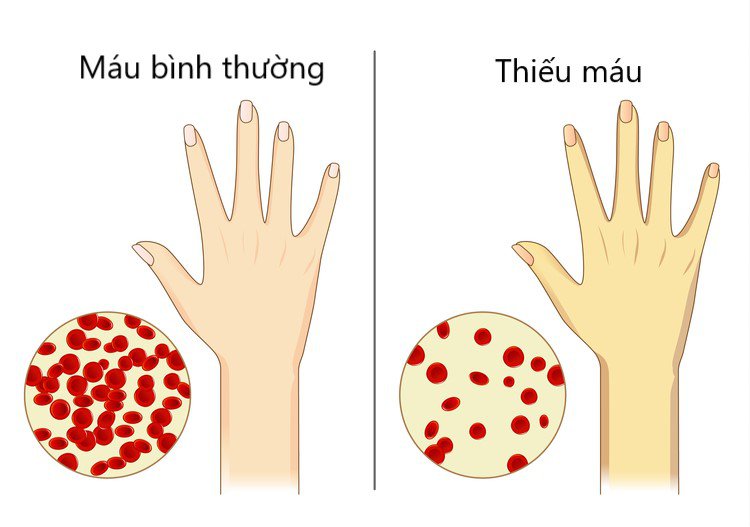 Tác hại của việc thiếu sắt và thiếu máu dinh dưỡng