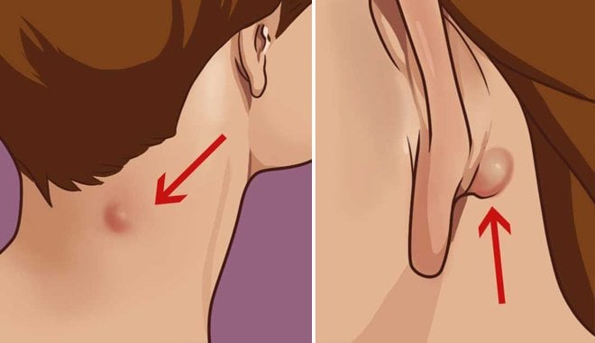 Hạch nổi sau cổ, gáy có đáng lo không ?