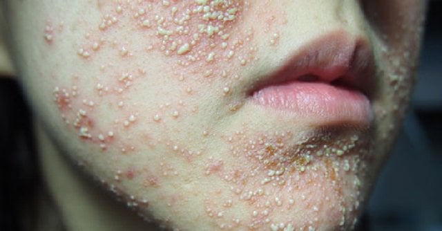 Cách điều trị và phục hồi da nhiễm corticoid