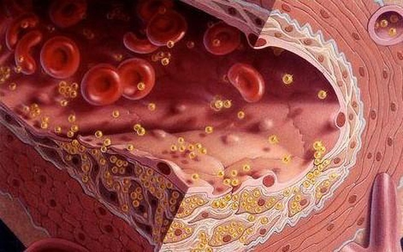 Người có mỡ máu cao thì cần có chế độ ăn giảm mỡ máu như thế nào?
