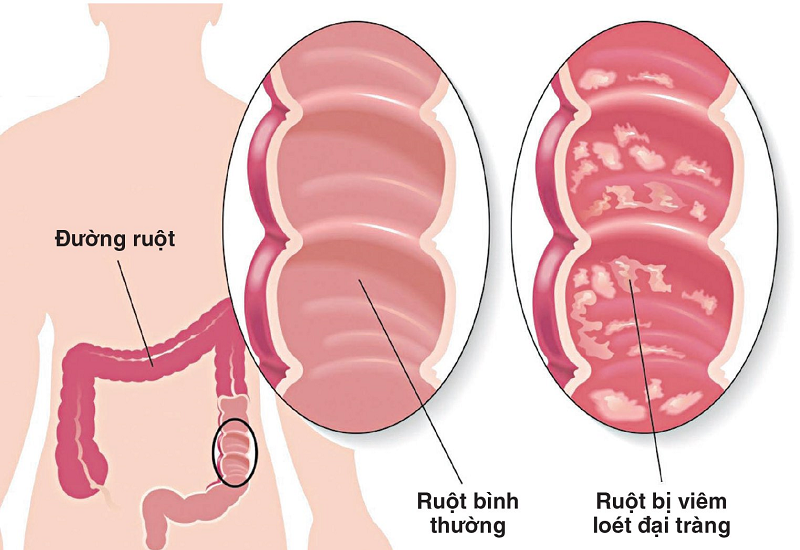 Người viêm đại tràng mãn tính cần ăn gì để cung cấp dinh dưỡng