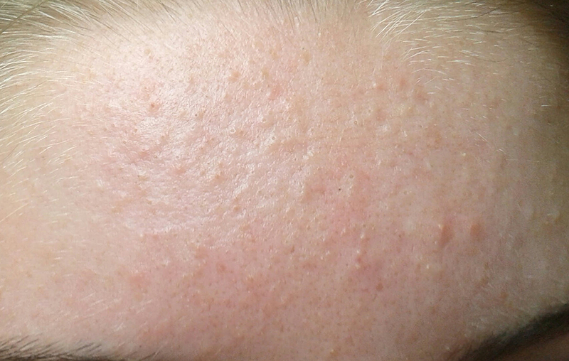 Mụn ẩn là gì? Biện pháp ngăn ngừa mụn ẩn dưới da