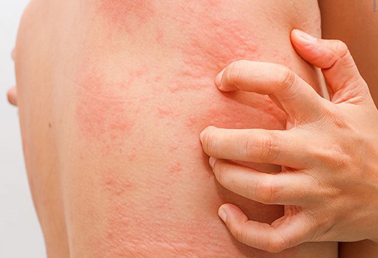 Hướng dẫn cách trị dị ứng cá biển