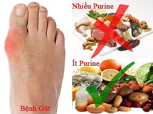 Bệnh nhân Gout nên biết về hàm lượng purin trong các loại thức ăn