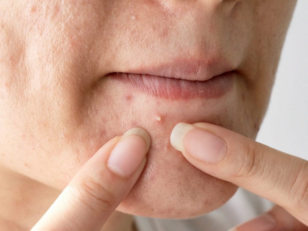 Chế độ dinh dưỡng cho da mụn nhanh khỏi, tránh để lại sẹo lồi