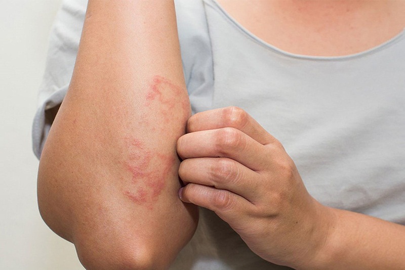 Nguyên nhân gây ngứa ran ở tay và chân