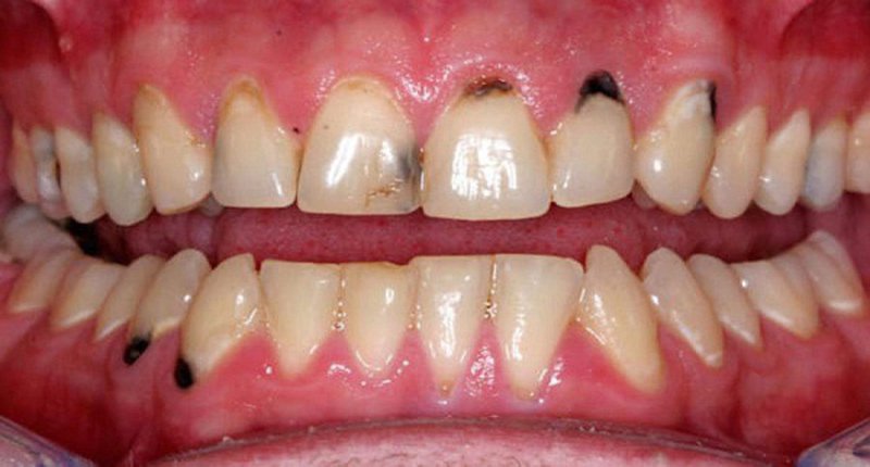Cách trị đốm đen trên răng tại nhà