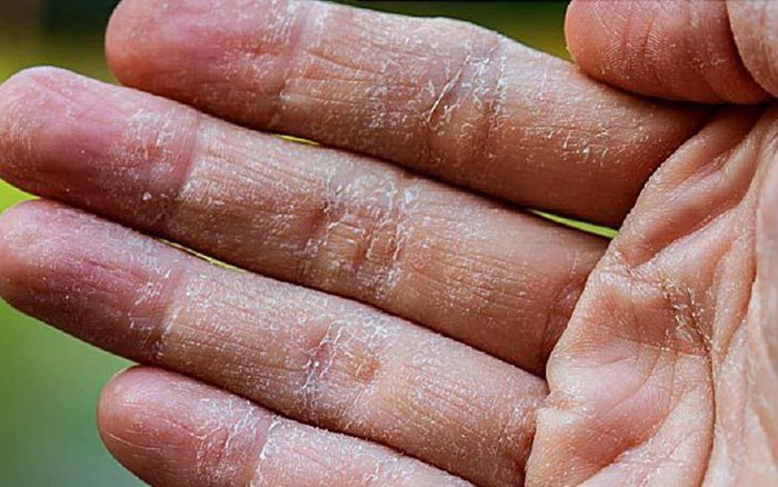 Khi bị tróc da tay thì cần xử lý như thế nào?