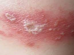 Bị kiến ba khoang cắn thì bôi thuốc gì?