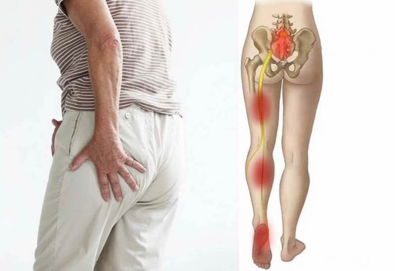 Đau thần kinh tọa là gì? Cách chẩn đoán và chữa trị hiệu quả