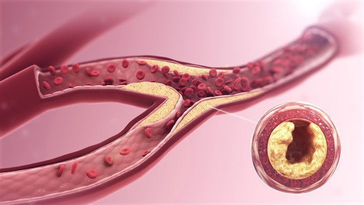 Mách bạn các loại thực phẩm có thể giúp ngăn ngừa tắc động mạch