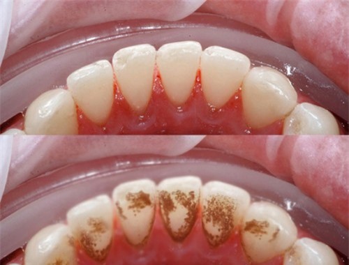 Cách trị đốm đen trên răng tại nhà