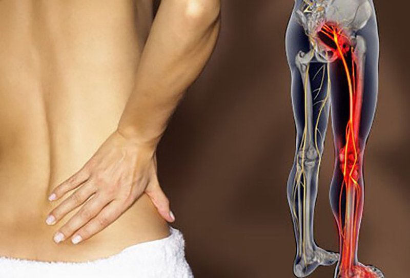 Đau thần kinh tọa là gì? Cách chẩn đoán và chữa trị hiệu quả