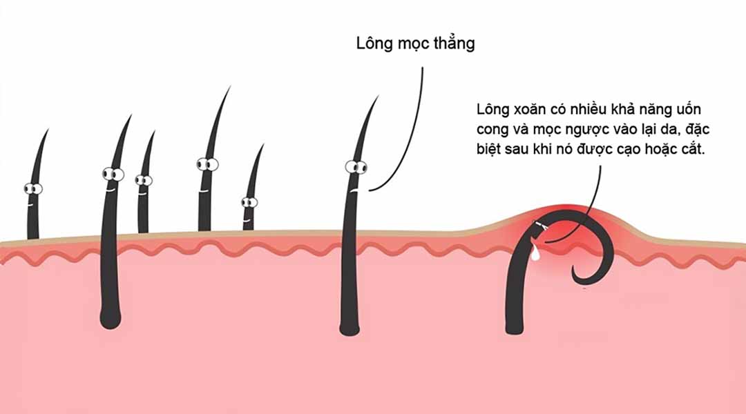 Hạch nổi sau cổ, gáy có đáng lo không ?