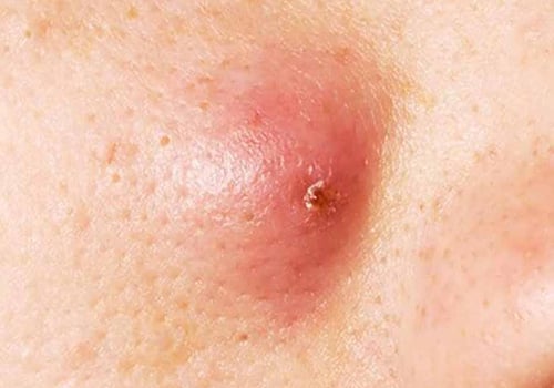 Lưu ý khi bị nổi cục cứng nhỏ dưới da