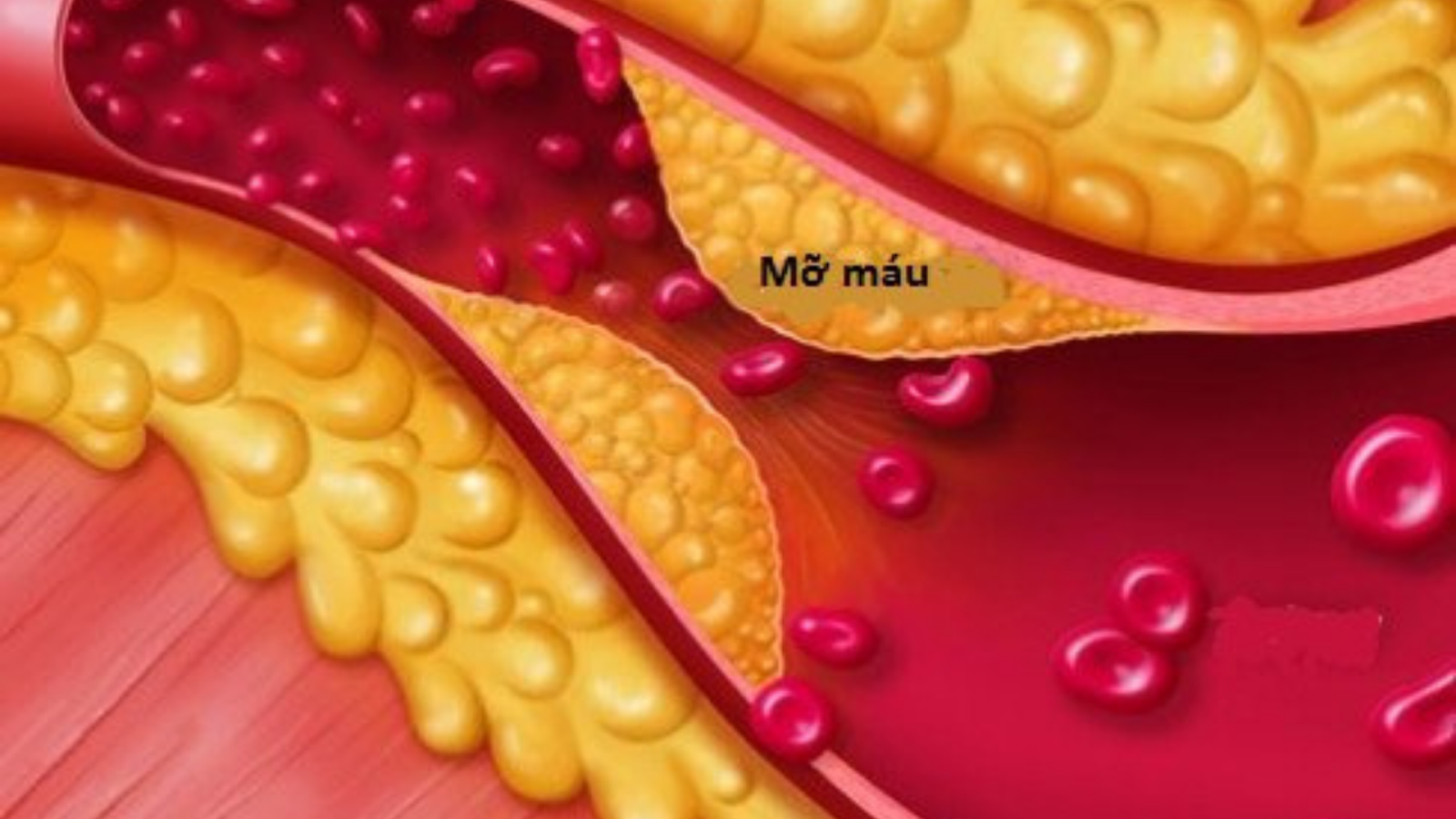 Mỡ máu cao nên kiêng thực phẩm gì?
