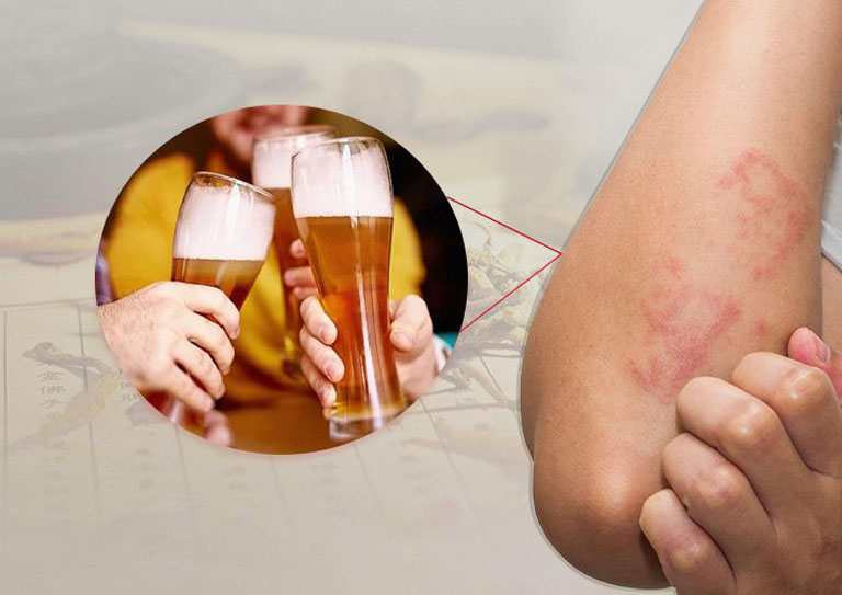 Dấu hiệu dị ứng bia không phải ai cũng biết
