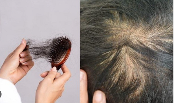 Rụng tóc có phải do thiếu sắt không?