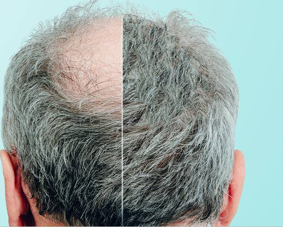 Rụng tóc có phải do thiếu sắt không?