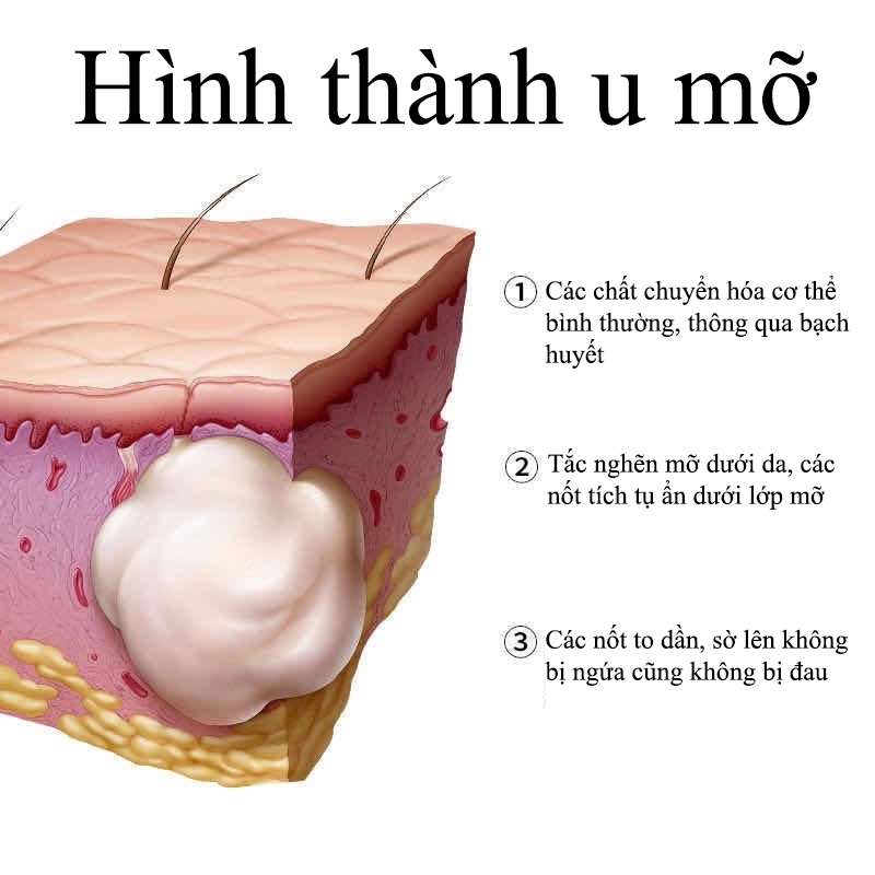 Hạch nổi sau cổ, gáy có đáng lo không ?