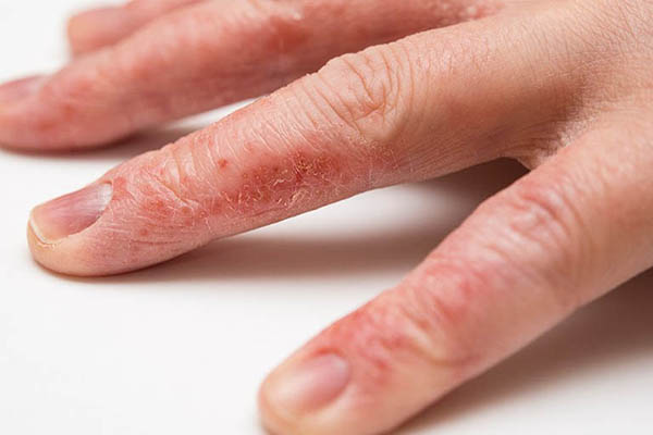 Khi bị tróc da tay thì cần xử lý như thế nào?