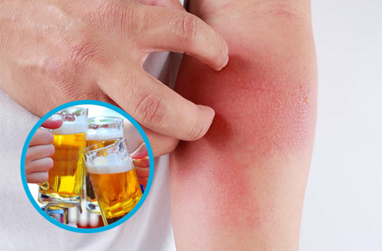 Dấu hiệu dị ứng bia không phải ai cũng biết