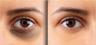 Tại sao mắt vẫn thâm khi ngủ đủ giấc?