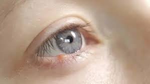 Vì sao mí mắt trên nổi mụn trắng nhỏ