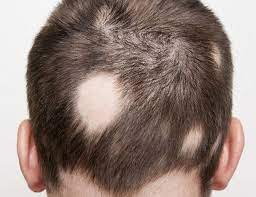 Một số nguyên nhân gây rụng tóc từng mảng (alopecia areata)