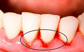 Thường xuyên bị chảy máu chân răng khi đánh răng có đáng lo không ?