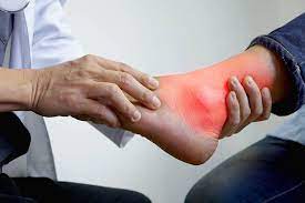 Dấu hiệu bệnh gút trên bàn chân và khớp