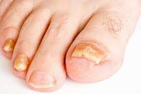 Tổng hợp các bệnh về lòng bàn chân
