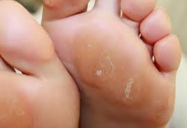 Tổng hợp các bệnh về lòng bàn chân