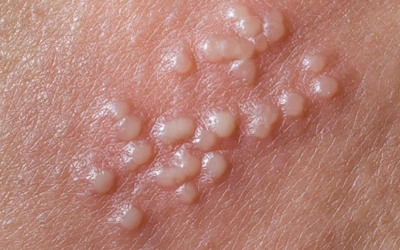 Nguyên nhân và cách điều trị mụn nước là gì?