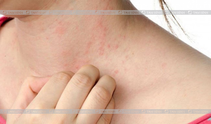 Người nóng bừng liệu có sốt không?
