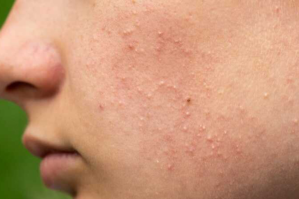 Mụn ẩn là gì? Biện pháp ngăn ngừa mụn ẩn dưới da