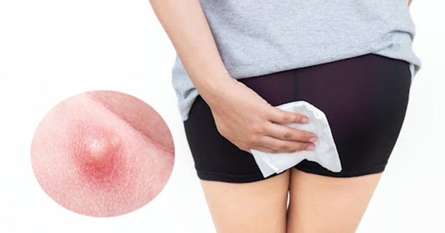 Cách xử lý khi bị nổi mụn nhọt ở hậu môn
