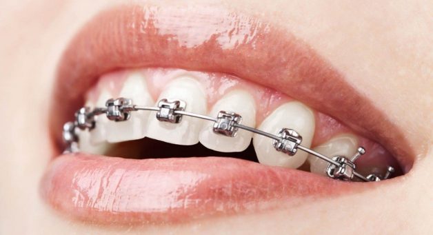 Niềng răng là gì? Lợi ích niềng răng mang lại như thế nào?