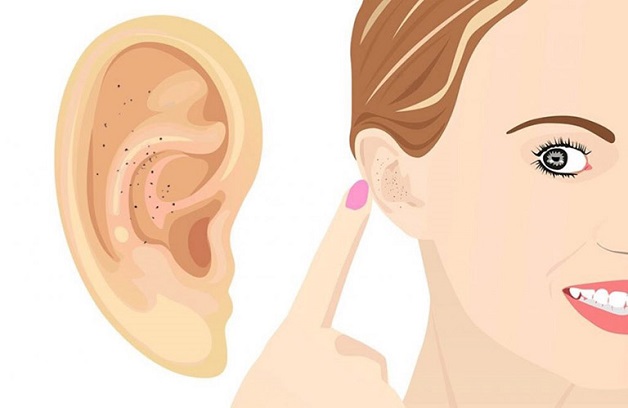 Xử trí khi bị mụn trong tai thế nào?