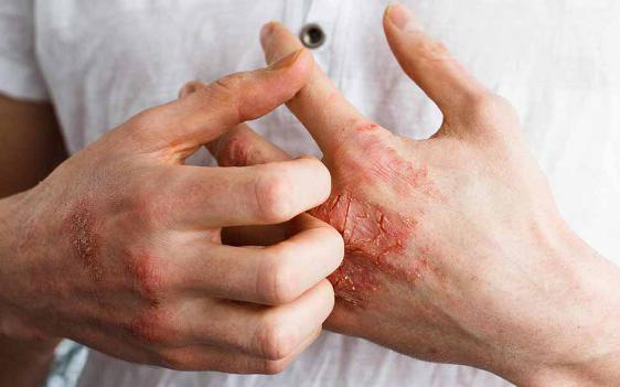 Nguyên nhân gây ngứa ran ở tay và chân