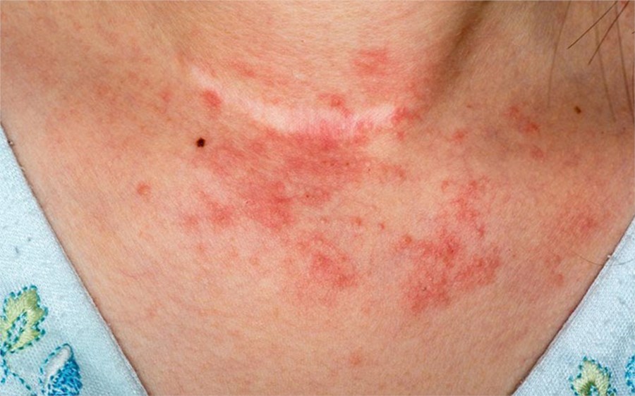 Triệu chứng của dị ứng rượu và cách xử lý