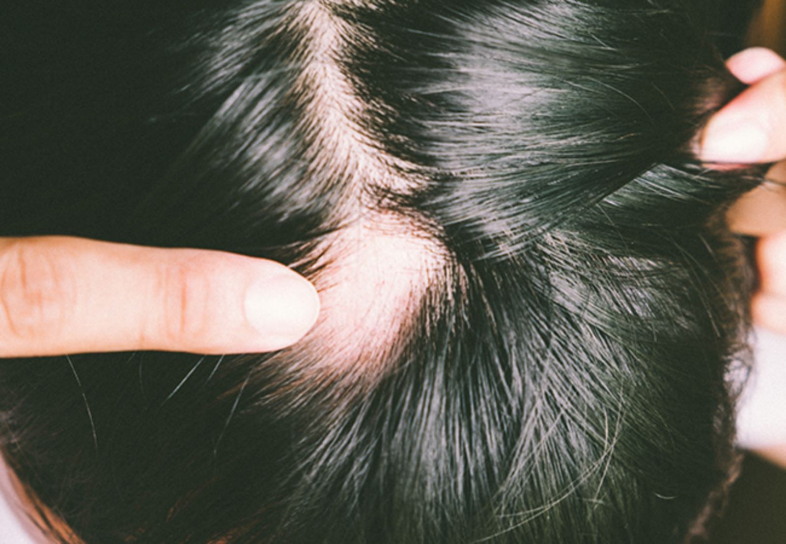 Một số lý do khiến bạn bị rụng lông trên cơ thể
