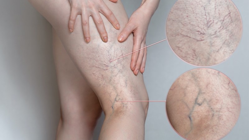 Chân bị giãn tĩnh mạch có nên massage không?
