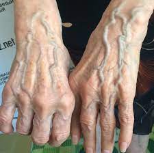 Sưng mạch máu ở tay là bị bệnh gì?