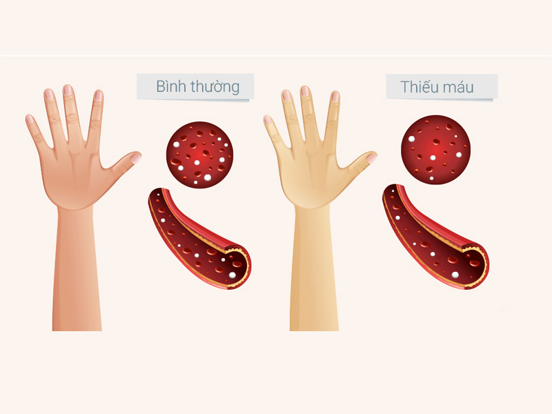Tác hại của việc thiếu sắt và thiếu máu dinh dưỡng