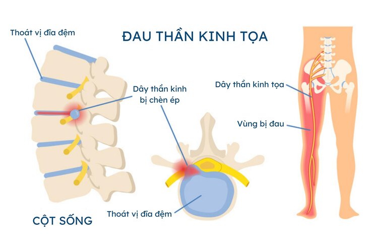 Đau thần kinh tọa là gì? Cách chẩn đoán và chữa trị hiệu quả